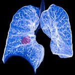 CMS Launches Comment Period for Lung Cancer Screening